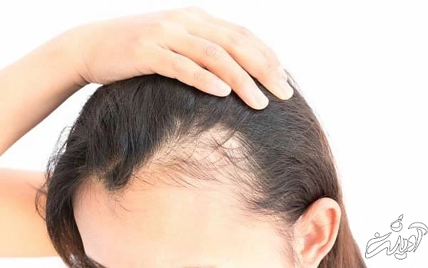 درمان ریزش مو 